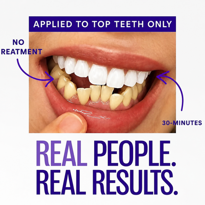 Zorivela®  whitening strips – Whiten Faster, Smile Brighter