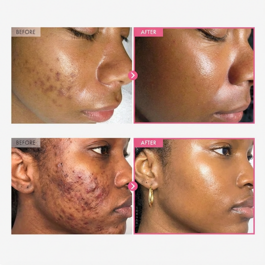 ✨Zorivela® Cream | Correct blemishes, dark spots and uneven skin tone